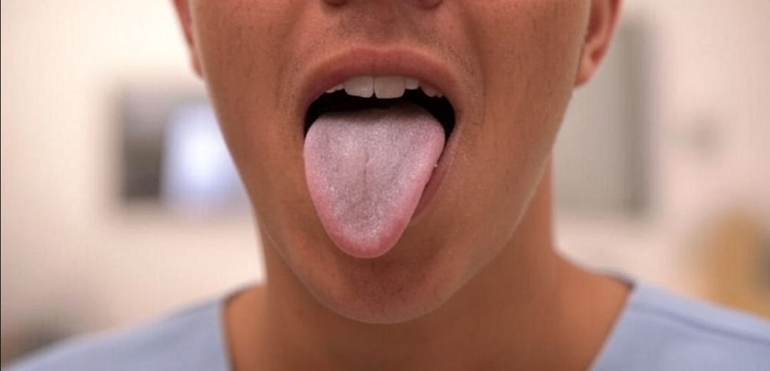If your tongue is white, this is a clear sign that you are suffering from…
