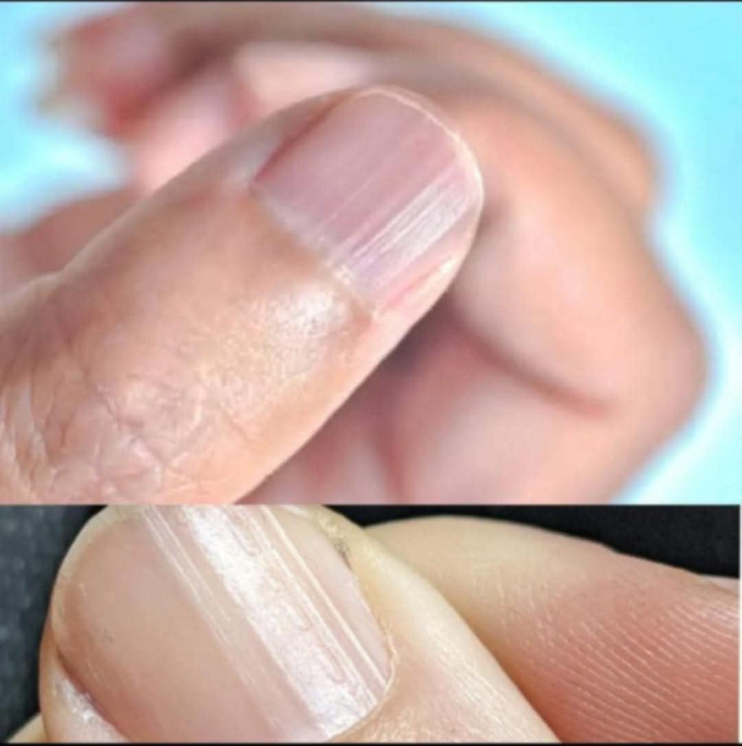 Having Striped Nails Could Mean That Your Body Is…
