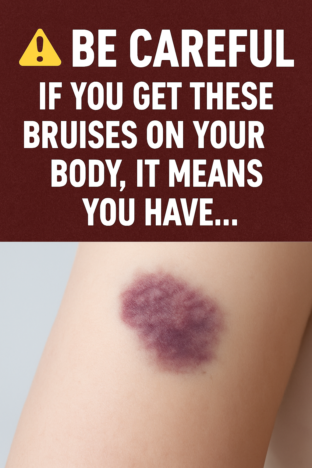 BE CAREFUL: If You Get These Mysterious Bruises on Your Body, It Might Mean Something Serious